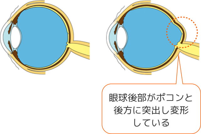 正視眼（左）と病的近視眼（右）の眼球の形
