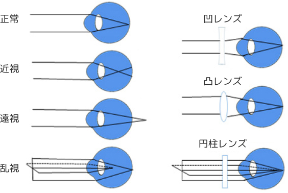 屈折異常とは何か？