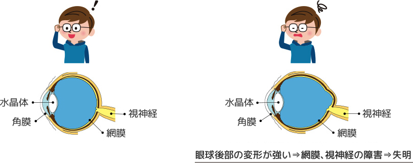 単純近視と病的近視