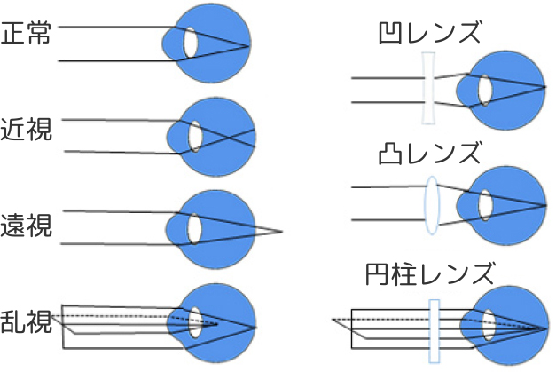 屈折異常とは何か？