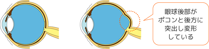正視眼（左）と病的近視眼（右）の眼球の形