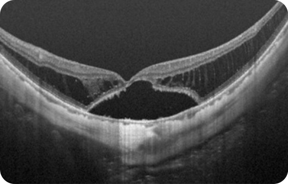 近視性牽引黄斑症のOCT画像　イメージ