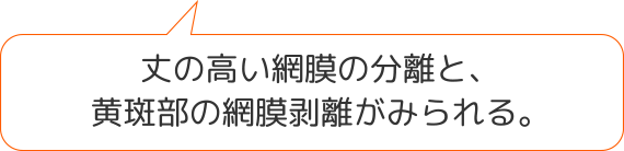 丈の高い網膜の分離と、黄斑部の網膜剥離がみられる。