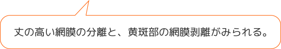 丈の高い網膜の分離と、黄斑部の網膜剥離がみられる。